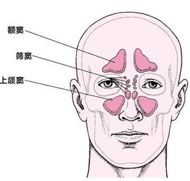 慢性副鼻窦炎
