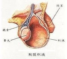 小儿鞘膜积液