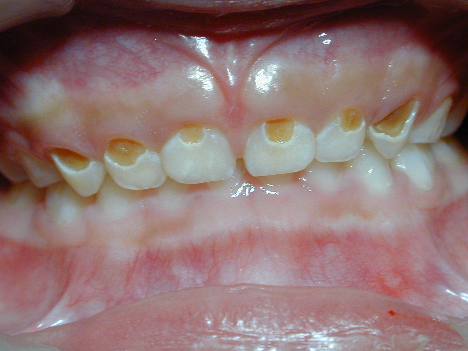 为哺乳动物体内最坚硬的组织,成熟的牙釉质为白色半透明的钙化程度最