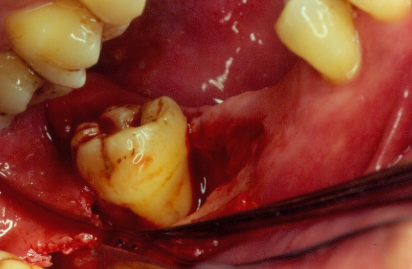 少数炎症严重者,可出现龈缘糜烂或肉芽增生.牙龈有时表面松软脆弱. 3.