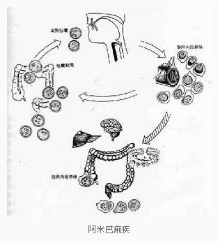 慢性阿米巴痢疾