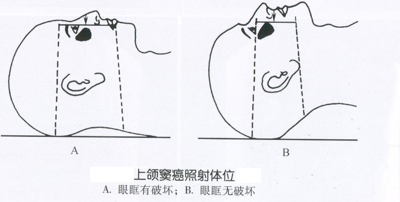 上颌窦癌