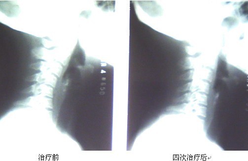 颈椎反弓