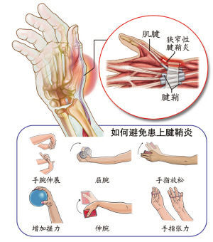 腱鞘炎