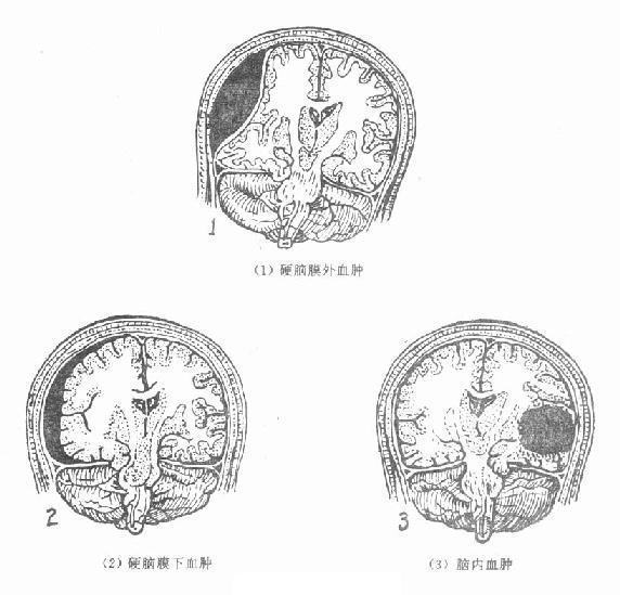 创伤性硬脑膜外血肿