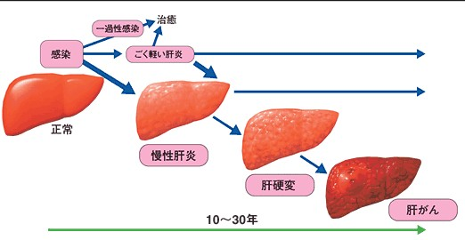 慢性活动性肝炎