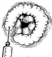 痔核脱出 360百科