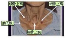 三凹征_360百科