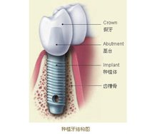 有关种植牙的具体过程介绍