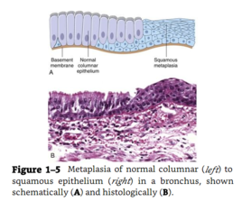 鳞状上皮化生 360百科