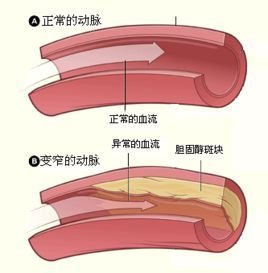 冠状动脉狭窄