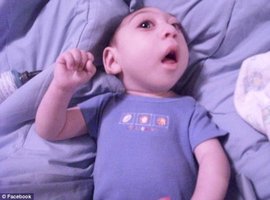 先天无脑畸形症