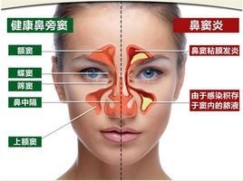 鼻炎防治，你了解多少？