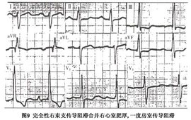 完全性右束支传导阻滞 360百科 完全性右束支传导阻滞 360百科