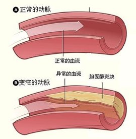 冠状动脉痉挛