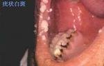 口腔粘膜疾病