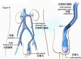 精索静脉曲张显微镜手术  免费编辑   添加义项名