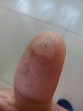 水疱 360百科 水疱 360百科