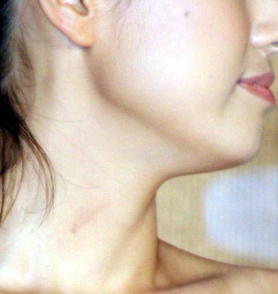 吻痕图册_360百科