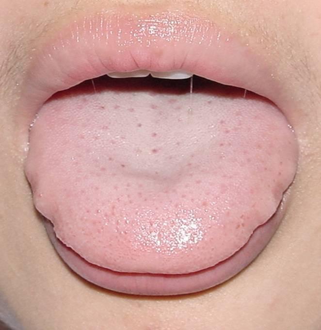 大舌是由脾之阳气虚衰,或兼寒湿而致舌体胖大,虚浮,嫩软色淡,常有齿痕