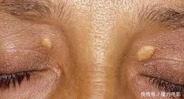 血脂高如何降低血脂