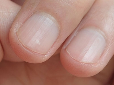 甲纵沟(皮肤病学 名词)