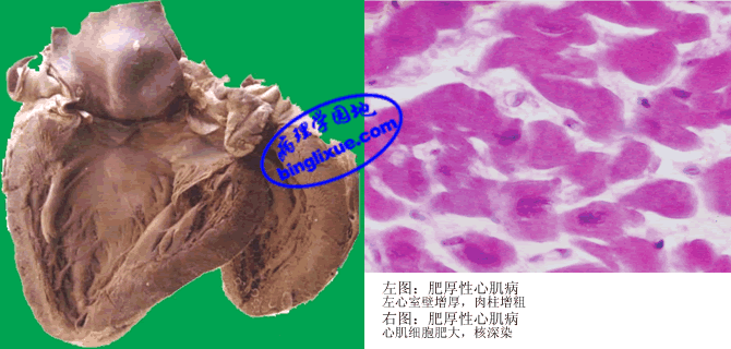 肥厚性心肌病_360百科