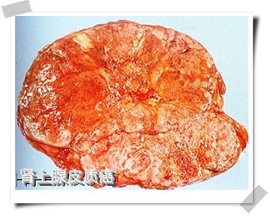肾上腺皮质癌内分泌病学名词