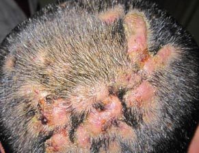头部脓肿性穿掘性毛囊周围炎皮肤病学名词
