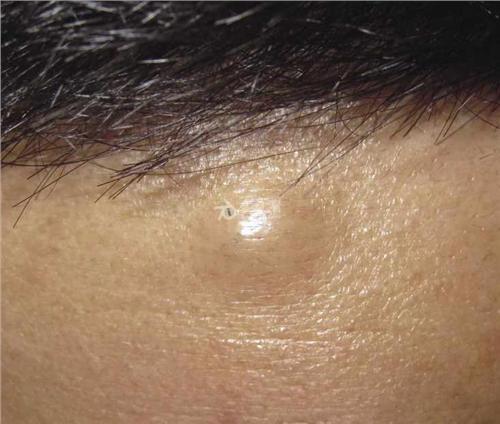 常见皮肤良性凸起瘤图片