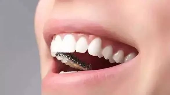 舌侧隐形矫正_360百科