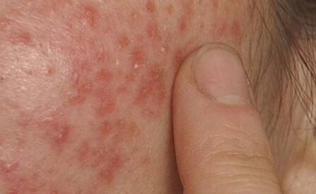 脂漏性皮肤炎图册_360百科