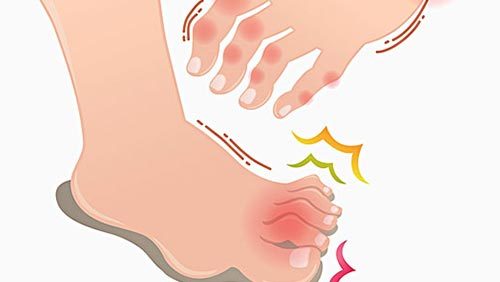 类风湿性关节炎