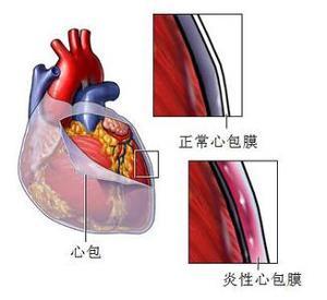 纤维心包图片