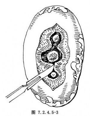 肾窦内肾盂切开取石术图片