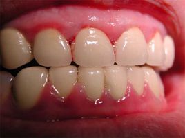 边缘龈(口腔医学 名词)边缘龈,又称游离龈,指包绕牙颈部的牙龈