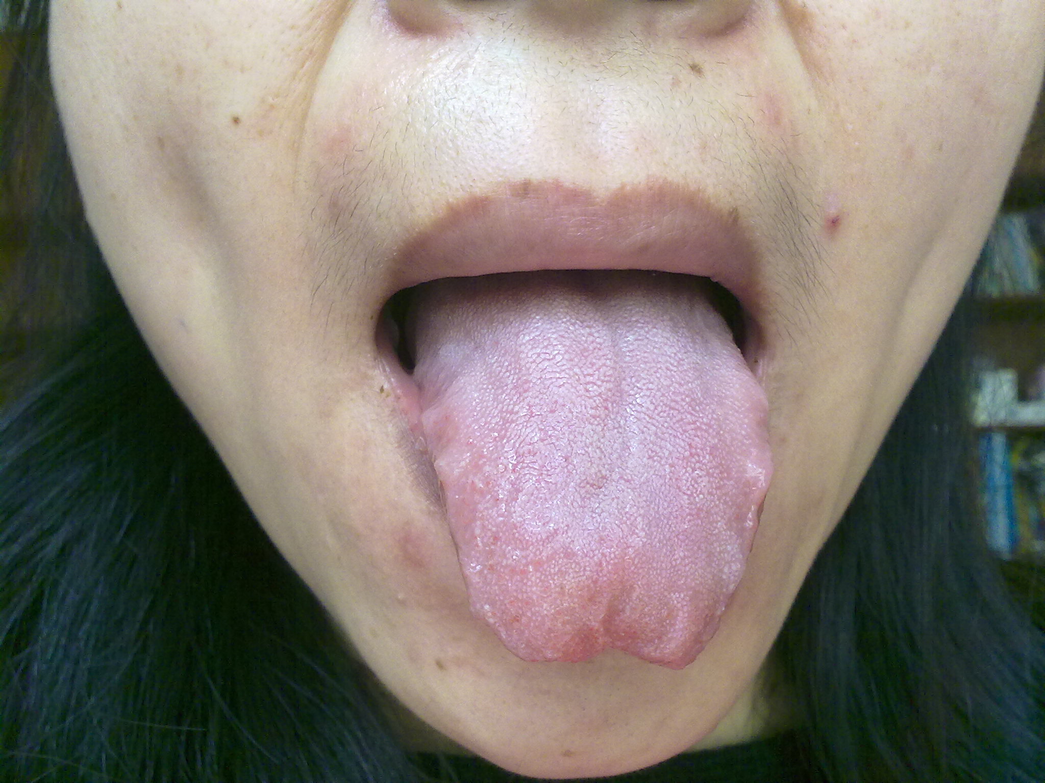 各种舌苔代表的什么？从舌苔看健康，看完之后你就成体检专家啦。 - 知乎