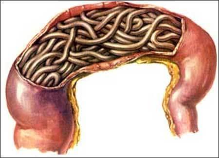 肠道寄生虫病 360百科