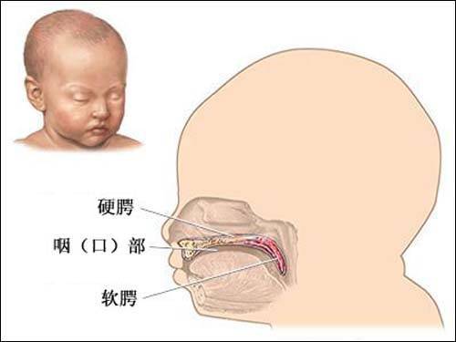 喉咙腭裂图片